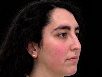 Case Studies Before & After Gallery - Patient 107943 - Image 1