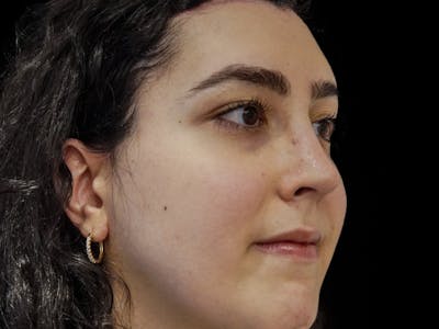 Case Studies Before & After Gallery - Patient 107943 - Image 2