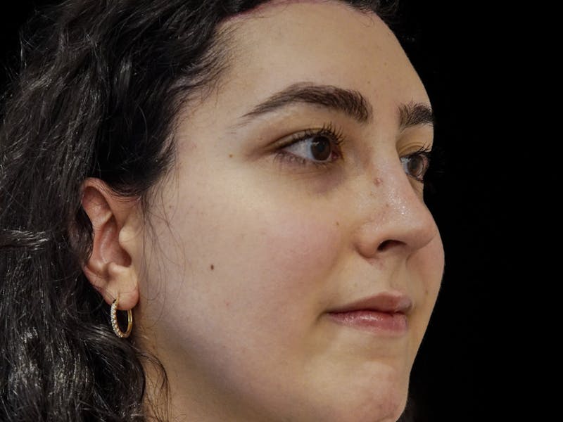 Case Studies Before & After Gallery - Patient 107943 - Image 2