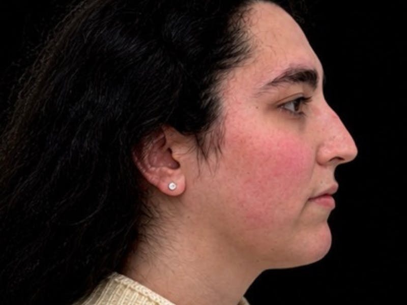 Case Studies Before & After Gallery - Patient 107943 - Image 3