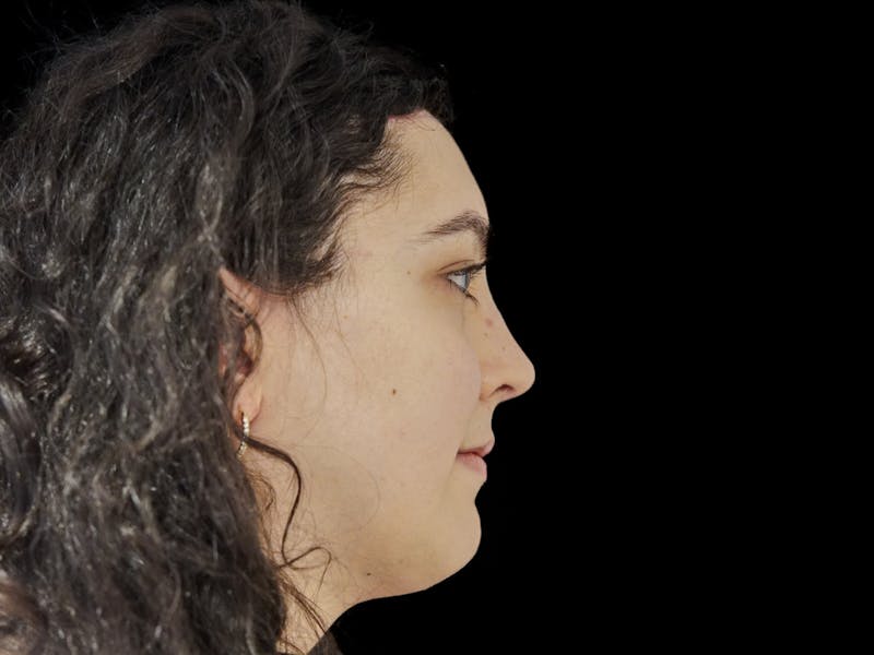 Case Studies Before & After Gallery - Patient 107943 - Image 4