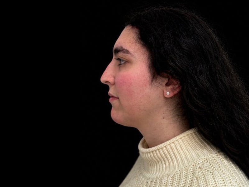 Case Studies Before & After Gallery - Patient 107943 - Image 5
