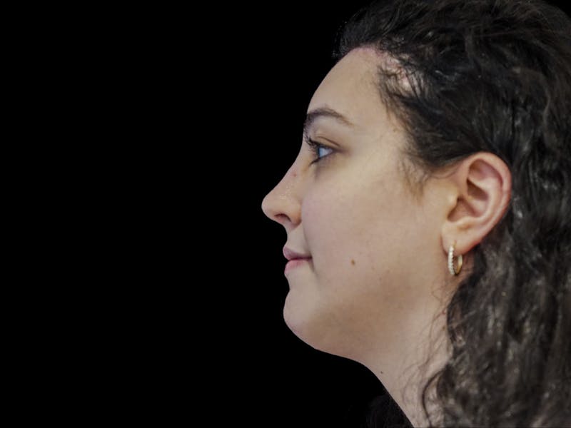 Case Studies Before & After Gallery - Patient 107943 - Image 6