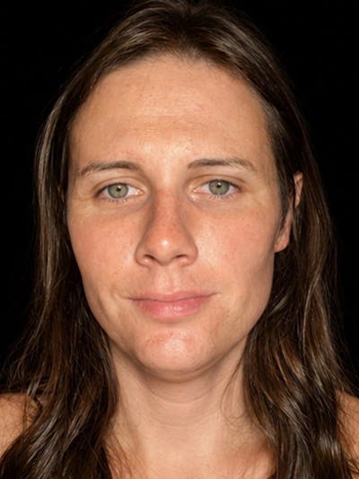 Case Studies Before & After Gallery - Patient 549648 - Image 1