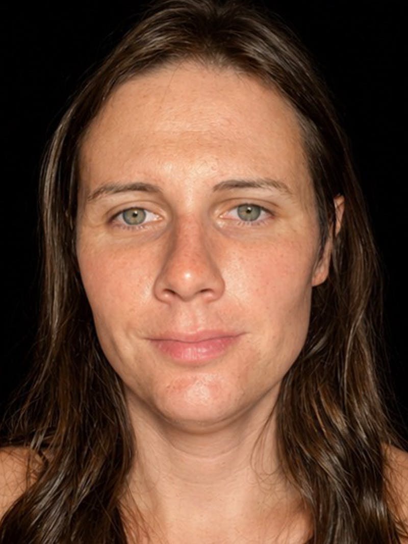Case Studies Before & After Gallery - Patient 549648 - Image 1