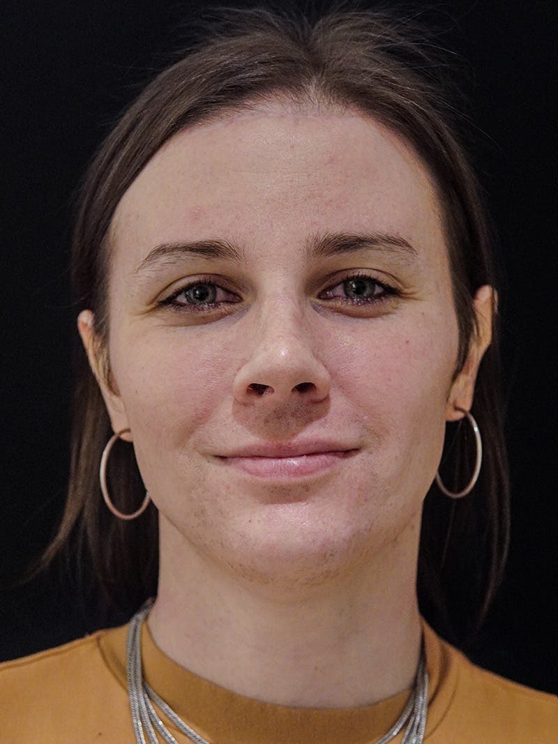 Case Studies Before & After Gallery - Patient 549648 - Image 2