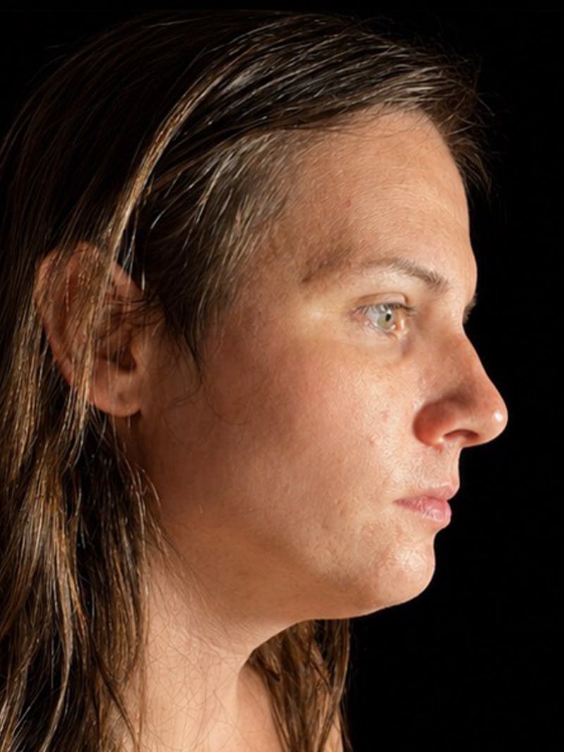 Case Studies Before & After Gallery - Patient 549648 - Image 3