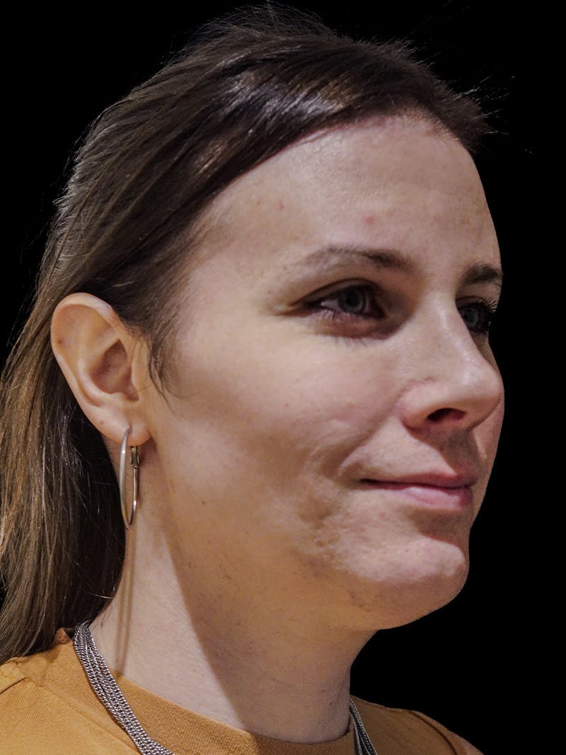 Case Studies Before & After Gallery - Patient 549648 - Image 4