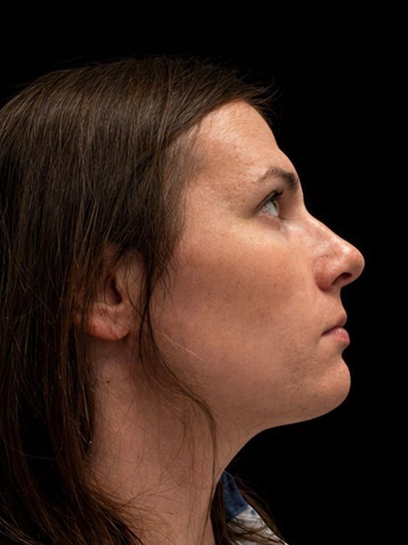 Case Studies Before & After Gallery - Patient 549648 - Image 5