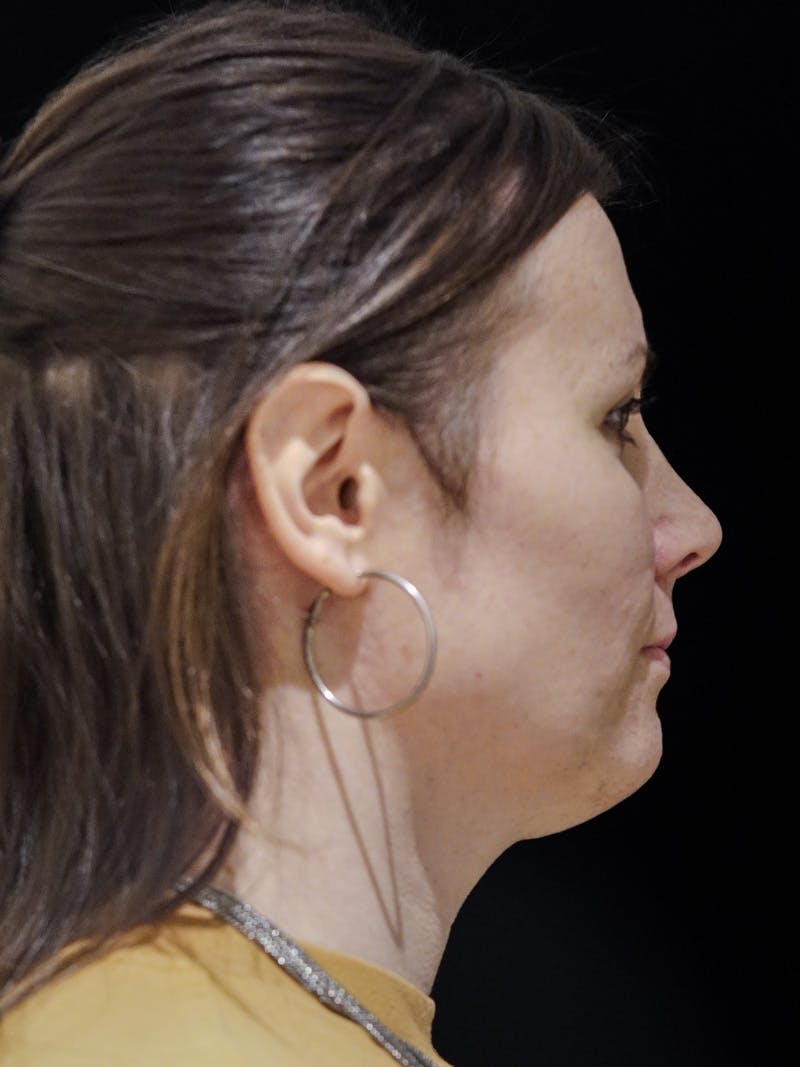 Case Studies Before & After Gallery - Patient 549648 - Image 6
