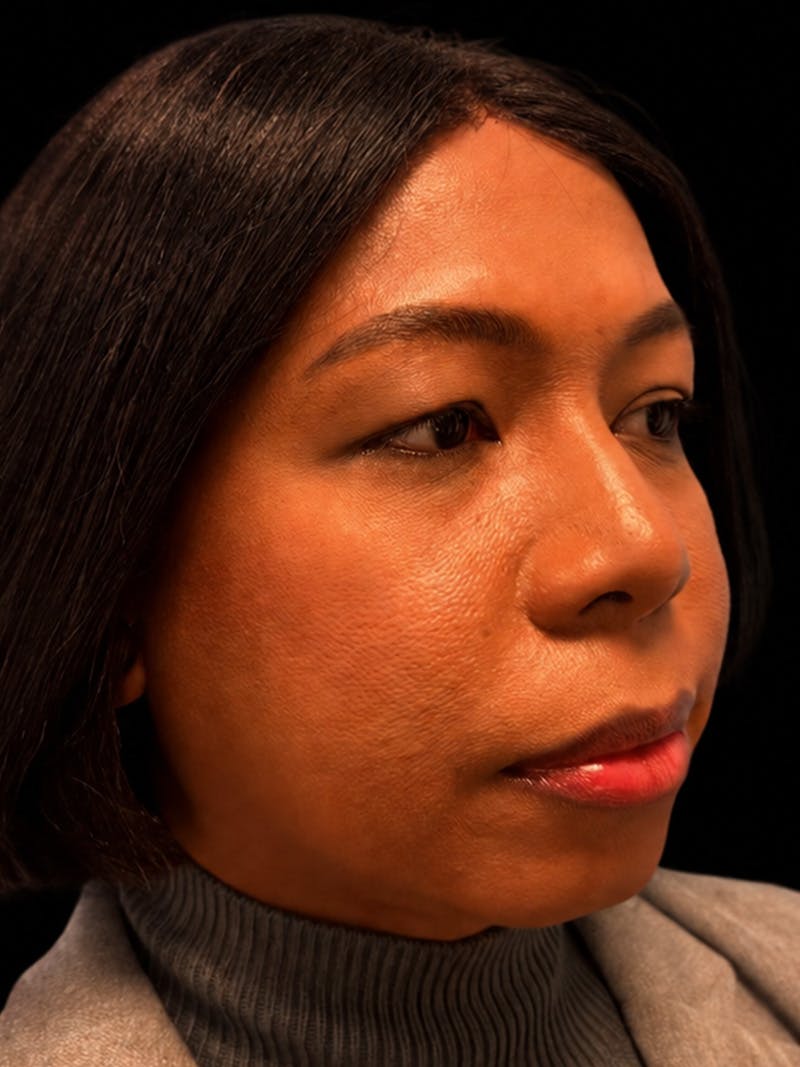 Case Studies Before & After Gallery - Patient 139295 - Image 1
