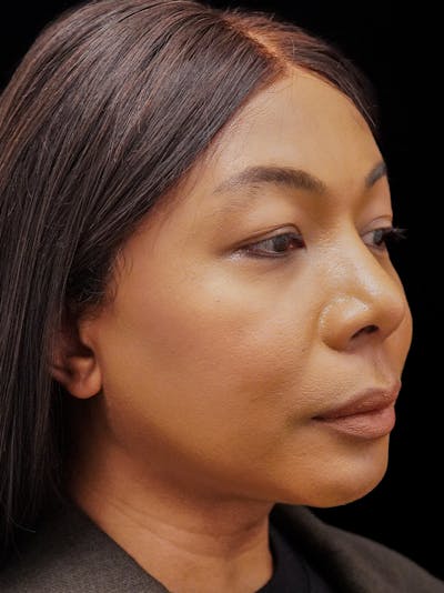 Case Studies Before & After Gallery - Patient 139295 - Image 2