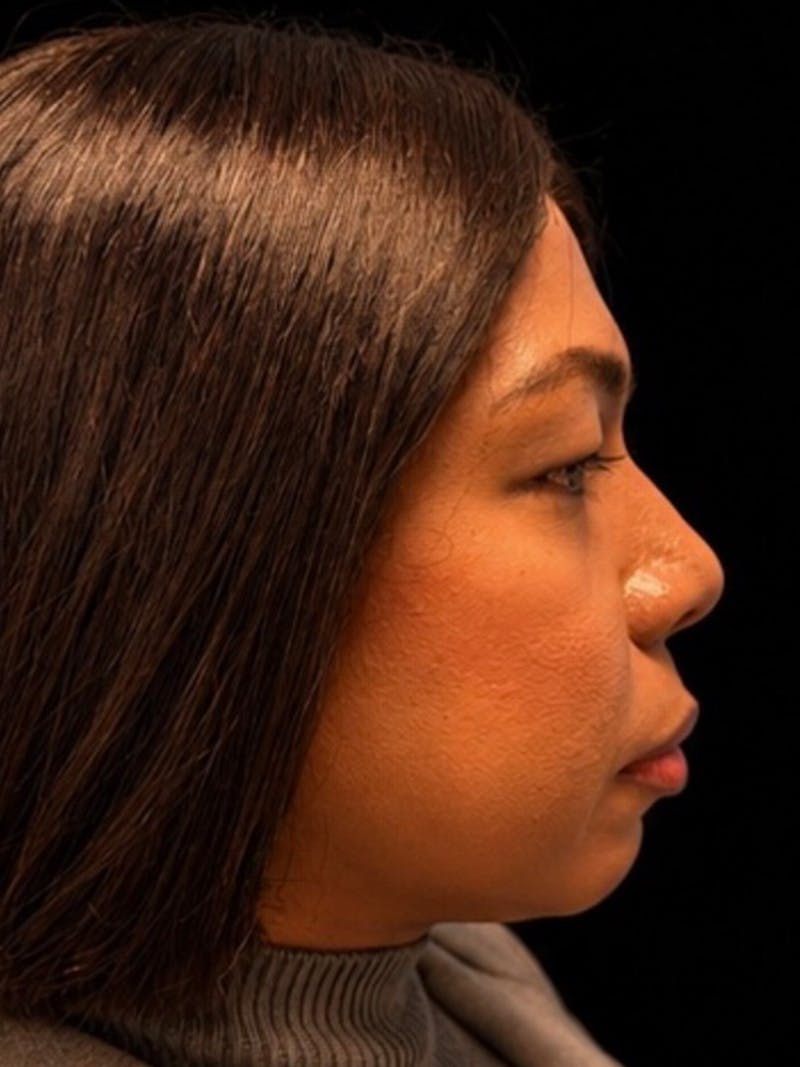 Case Studies Before & After Gallery - Patient 139295 - Image 3