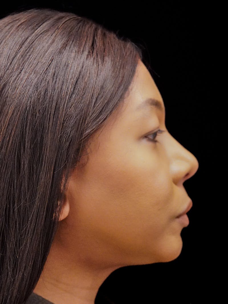 Case Studies Before & After Gallery - Patient 139295 - Image 4
