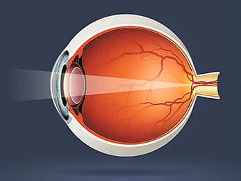 In A Normal Eye, Light Passes Through The Clear Lens And Focuses On The Retina.