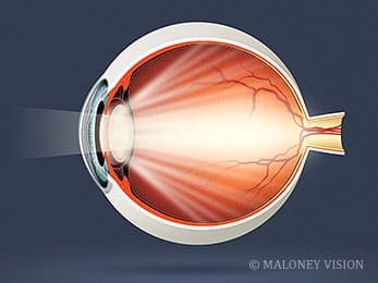 A Clouded Lens Or Cataract Causes The Light To Scatter Across The Retina.