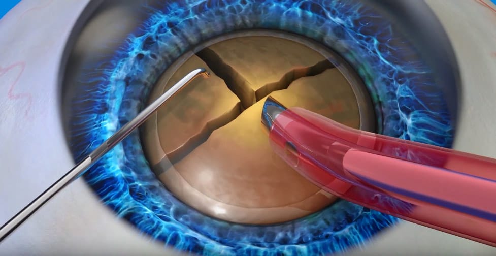 Manual cataract surgery graphic