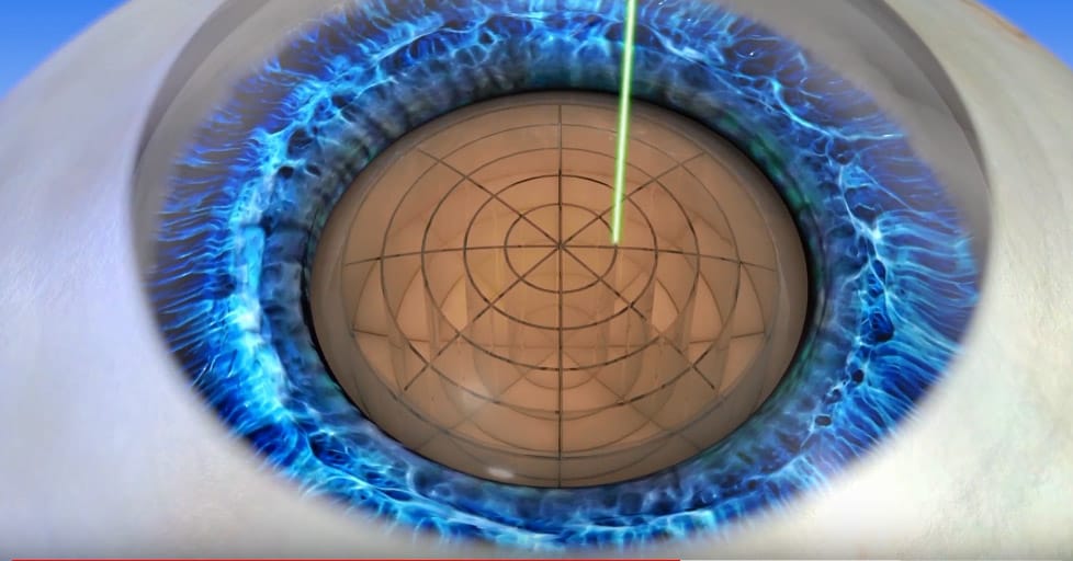 Laser cataract surgery graphic