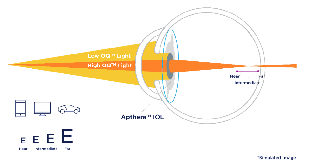 Apthera IOL graphic