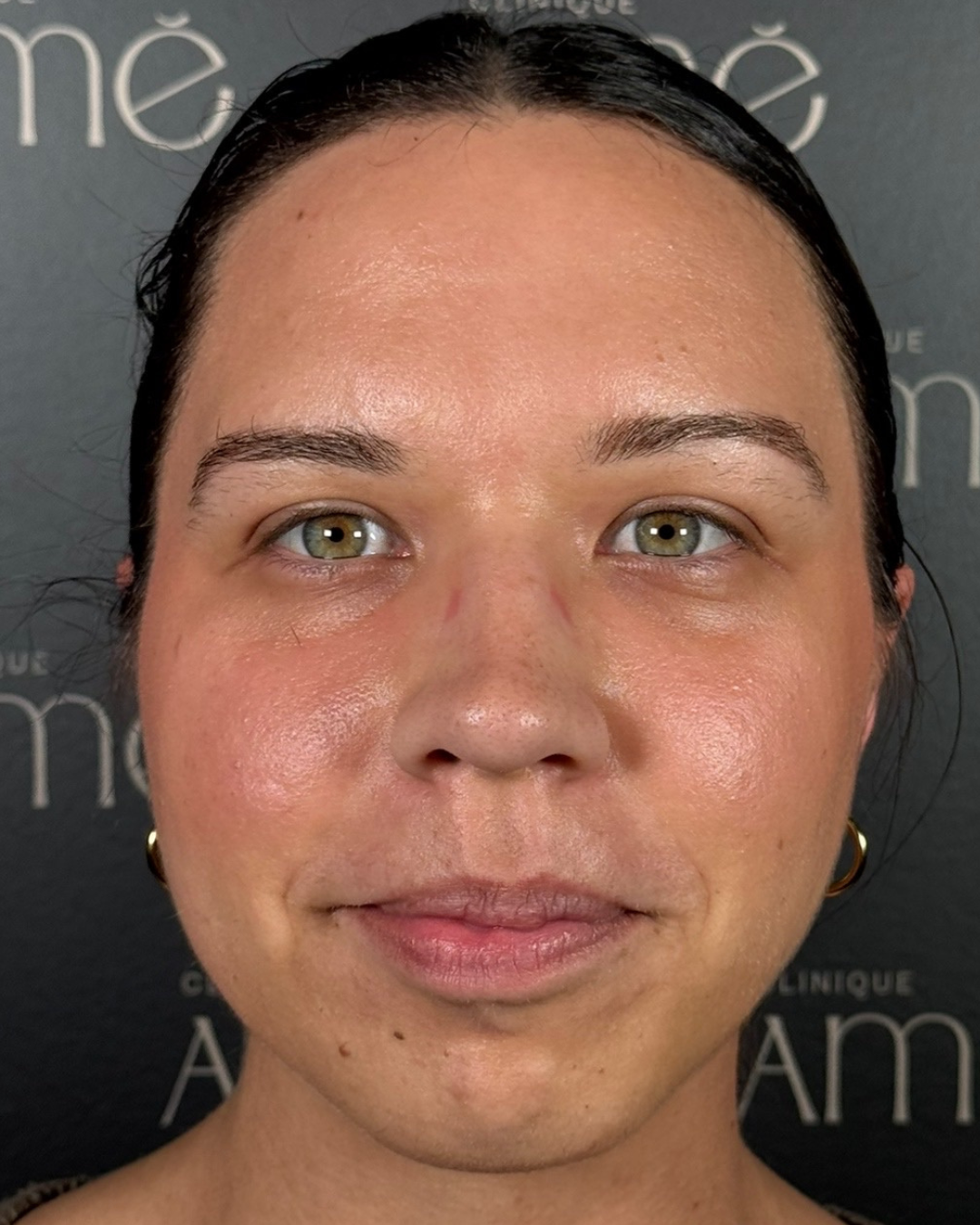 Before: injectable treatment