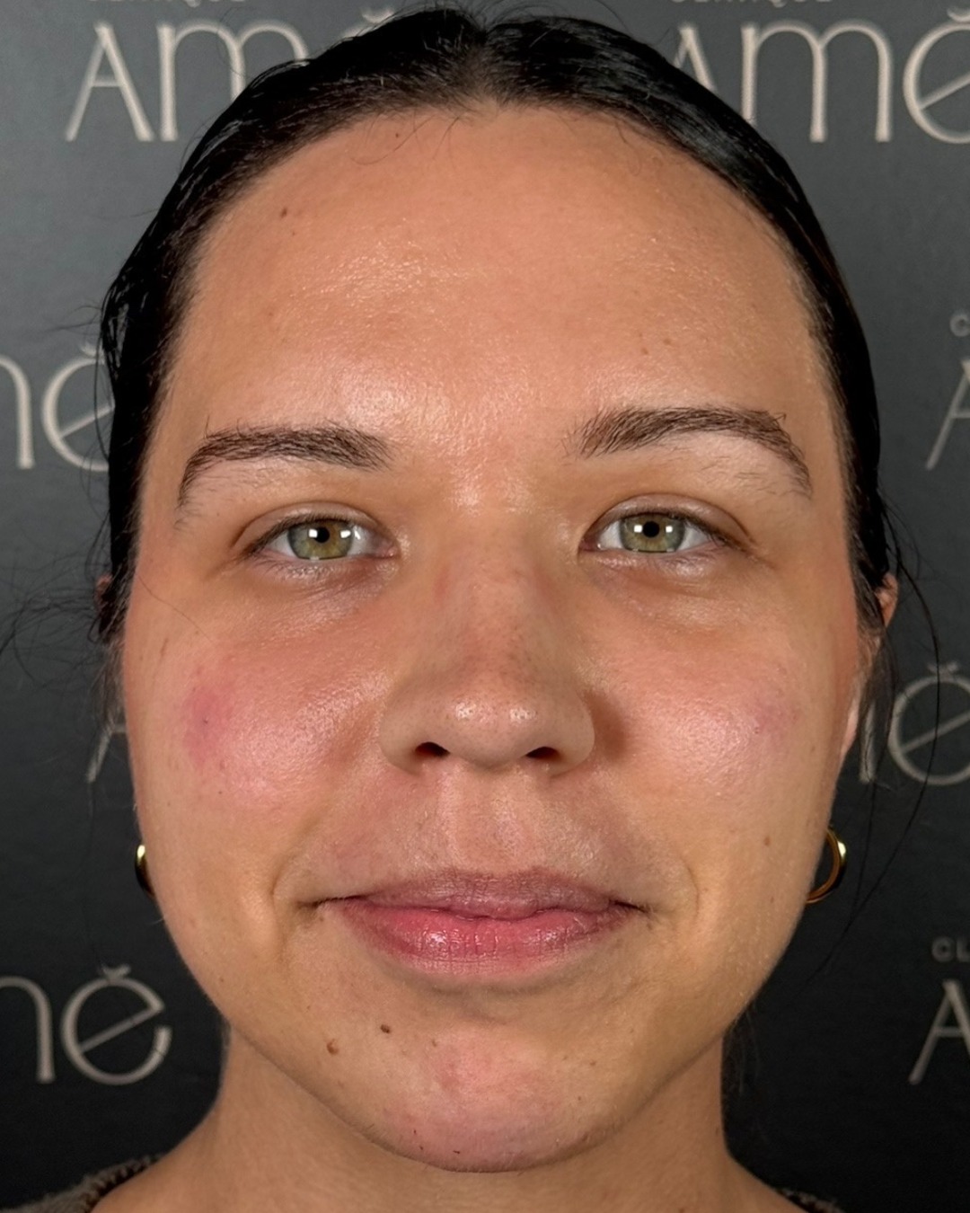 After: injectable treatment