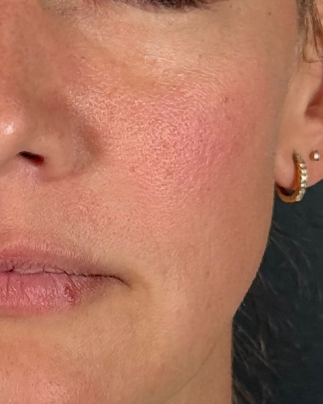 Before: vascular laser for redness