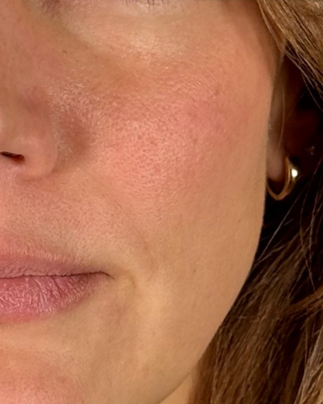 After: vascular laser for redness