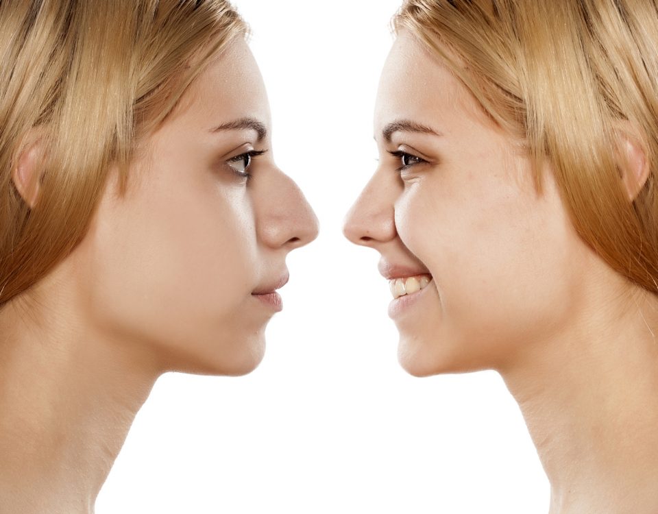 Vail Valley Plastic Surgery and Skin Care Blog | 7 Benefits Of Rhinoplasty Surgery
