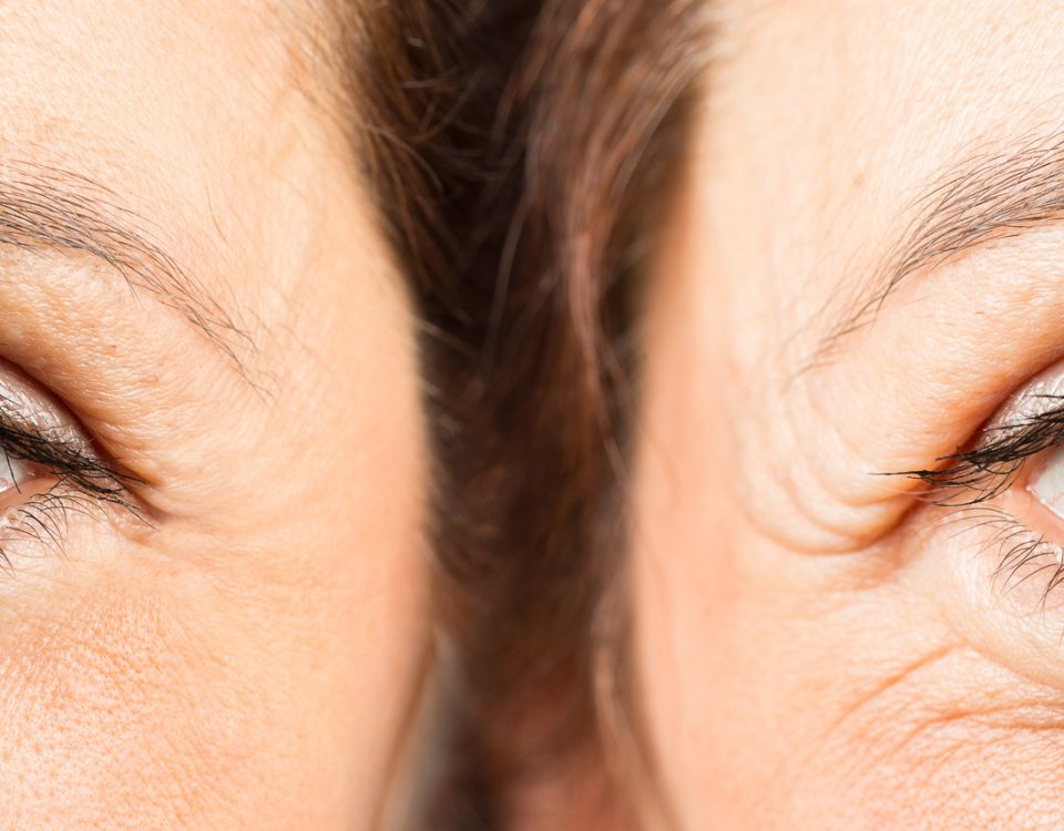 Vail Valley Plastic Surgery and Skin Care Blog | How To Decide Between Eyelid Surgery Or Brow Lift