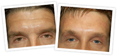 Brow Lift Before & After Gallery - Patient 10380773 - Image 1