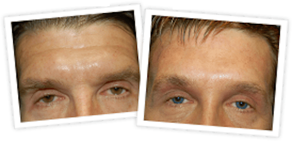 Brow Lift Before & After Gallery - Patient 10380773 - Image 1