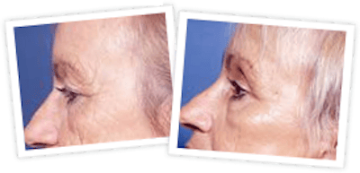 Brow Lift Before & After Gallery - Patient 10380770 - Image 1