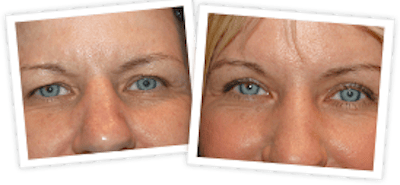 Brow Lift Before & After Gallery - Patient 10380768 - Image 1