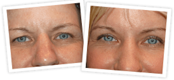 Brow Lift Before & After Gallery - Patient 10380768 - Image 1