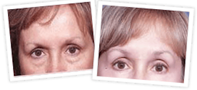 Brow Lift Before & After Gallery - Patient 10380767 - Image 1