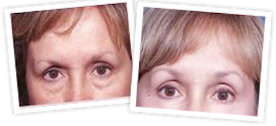 Brow Lift