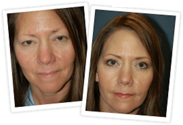 Rhinoplasty Before & After Gallery - Patient 10380754 - Image 1