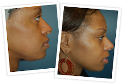 Rhinoplasty