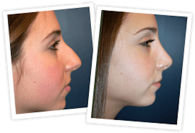 Rhinoplasty Before & After Gallery - Patient 10380752 - Image 2