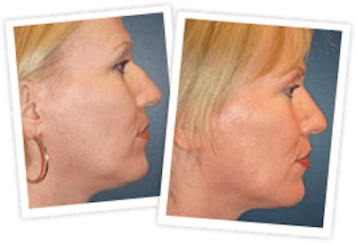 Rhinoplasty Before & After Gallery - Patient 10380538 - Image 1