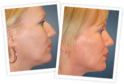 Rhinoplasty