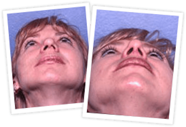 Rhinoplasty Before & After Gallery - Patient 10380533 - Image 1