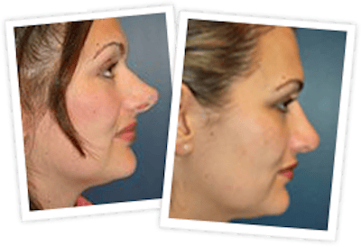 Rhinoplasty Before & After Gallery - Patient 10380531 - Image 1