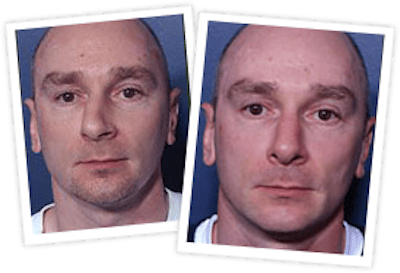 Rhinoplasty Before & After Gallery - Patient 10380530 - Image 1