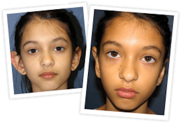 Ear Pinning Before & After Gallery - Patient 10380480 - Image 1