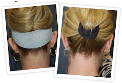 Ear Pinning Before & After Gallery - Patient 10380481 - Image 1