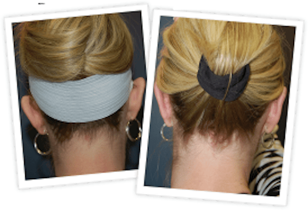 Ear Pinning Before & After Gallery - Patient 10380481 - Image 1