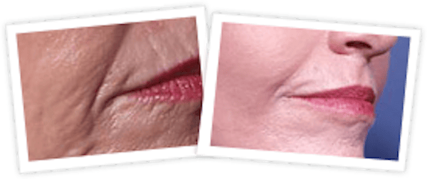 Chemical Peel / Skin Resurfacing Before & After Gallery - Patient 10380760 - Image 1