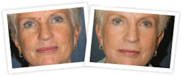Chemical Peel / Skin Resurfacing Before & After Gallery - Patient 10380761 - Image 1
