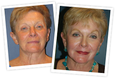 Skin Resurfacing